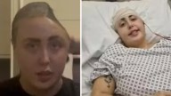 Mujer pierde parte del cráneo tras caerse por las escaleras mientras bebía con una amiga: 'Un error tonto casi me mata'