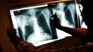 Maine reports 3 active TB cases, world's deadliest infectious disease