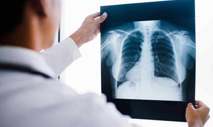 Opportunistic chest X-rays effective in identifying bone loss risk: Study