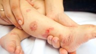 Dermatitis atópica: evolución de los fármacos más allá del alivio temporal