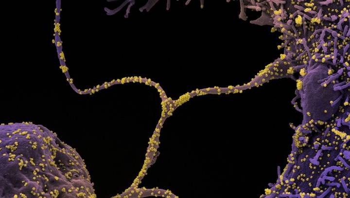 Doctors Report The Longest-Known COVID-19 Infection Lasting 776 Days