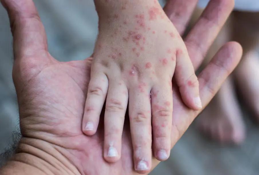Medidas clave para prevenir el virus Coxsackie y proteger a niños menores de cinco años