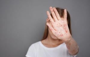 Measles Outbreak Spreads in Arizona-Utah Border Communities