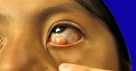 Salud pública histórica: México cumple 10 años sin oncocercosis