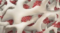 Modified Glue Gun Delivers Personalized Fracture Treatment