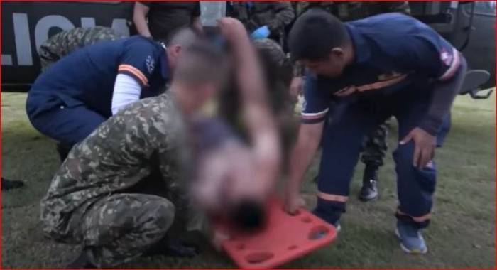 Putumayo: Un soldado sufrió quemaduras en el 75% de su cuepo