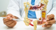 Cáncer de colon: diarrea y estreñimiento persistentes pueden ser señales de alarma