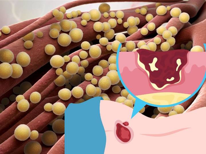 Cómo prevenir la sepsis