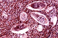 La amenaza de los gusanos de la esquistosomiasis, la enfermedad emergente que ya se ha transmitido en España