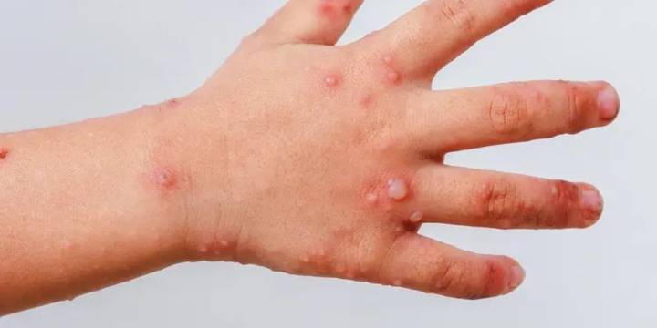 Reportan incremento de casos de virus Coxsackie en Calkiní, Campeche