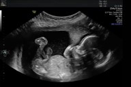 Pregnant Woman Asked How 20-Week Anatomy Scan Went, Video Says It All