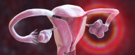 Hysterectomy Significantly Raises Risk of Stroke, New Evidence Suggests