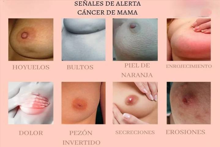 Cáncer de mama: cómo la información y la prevención salvan vidas