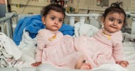 15-Month-Old Conjoined Twins Successfully Separated After 18
