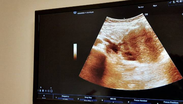 Lanzan iniciativa multimillonaria para la prevención de la muerte fetal intrauterina