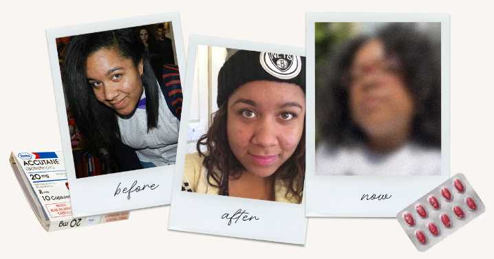 A Look Back at My Accutane Journey