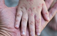 Brote de Coxsackie en Tulum obliga el cierre preventivo de un jardín de niños
