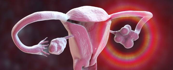 Hysterectomy Significantly Raises Risk of Stroke, New Evidence Suggests