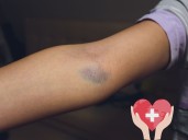 Moretones que aparecen con facilidad: causas, prevención y cuándo acudir al médico