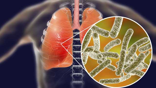 What people should know about Legionnaires’ disease