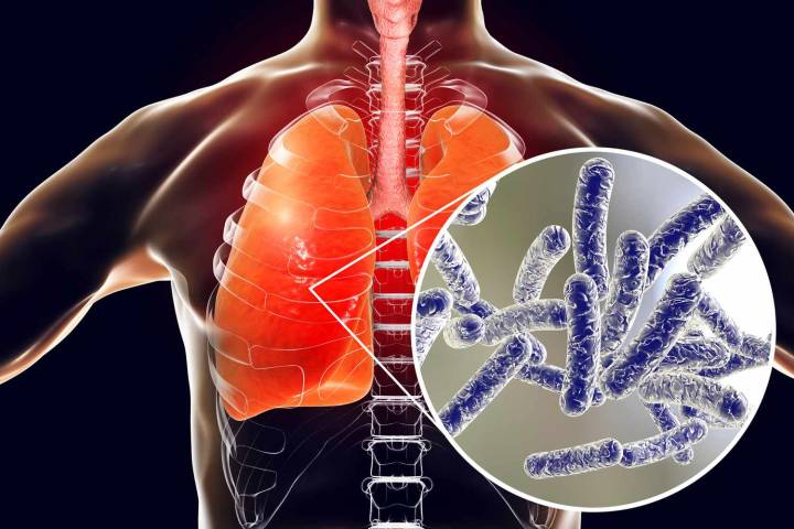 2 Dead, Dozens Sickened in Legionnaires' Outbreak in New York City Suburb