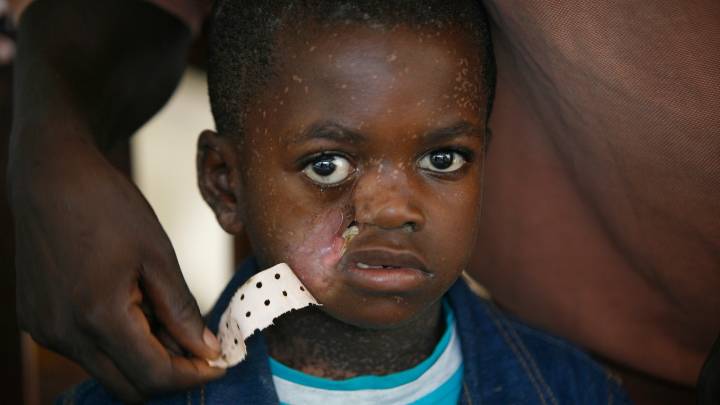 Investigadores españoles detectan por primera vez la enfermedad mortal del noma en Mozambique