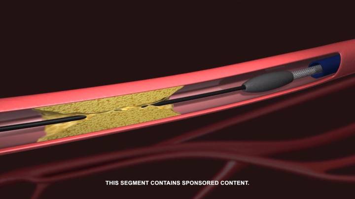 Veryan Rotational Atherectomy System