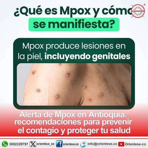Alerta de Mpox en Antioquia: recomendaciones para prevenir el contagio y proteger tu salud
