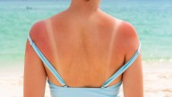 Skin cancer: Research finds just one bout of severe sunburn increases cutaneous squamous cell carcinoma risk