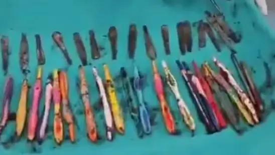 19 Toothbrushes, 29 Spoons, 2 Pens: All These Removed From Man’s Abdomen!