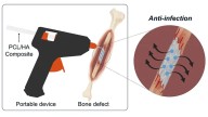 Científicos revolucionan el tratamiento de fracturas con un invento futurista