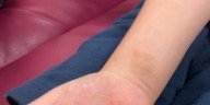 Placenta donation having a huge impact on burn care in Southern Nevada hospitals