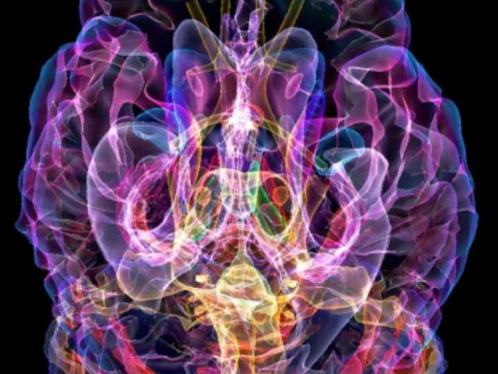 Hito para la neurociencia: Oxford diseñó un casco de ultrasonido que podría tratar el Parkinson sin cirugía