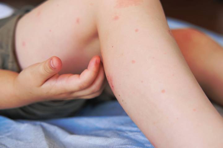 Feeling itchy? Orkin finds Cleveland is a hot bed for 2 tiny terrors