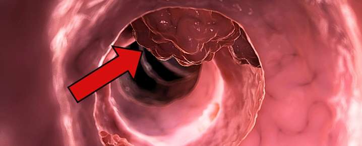 A Common Medicine May Stop Colorectal Cancer From Returning