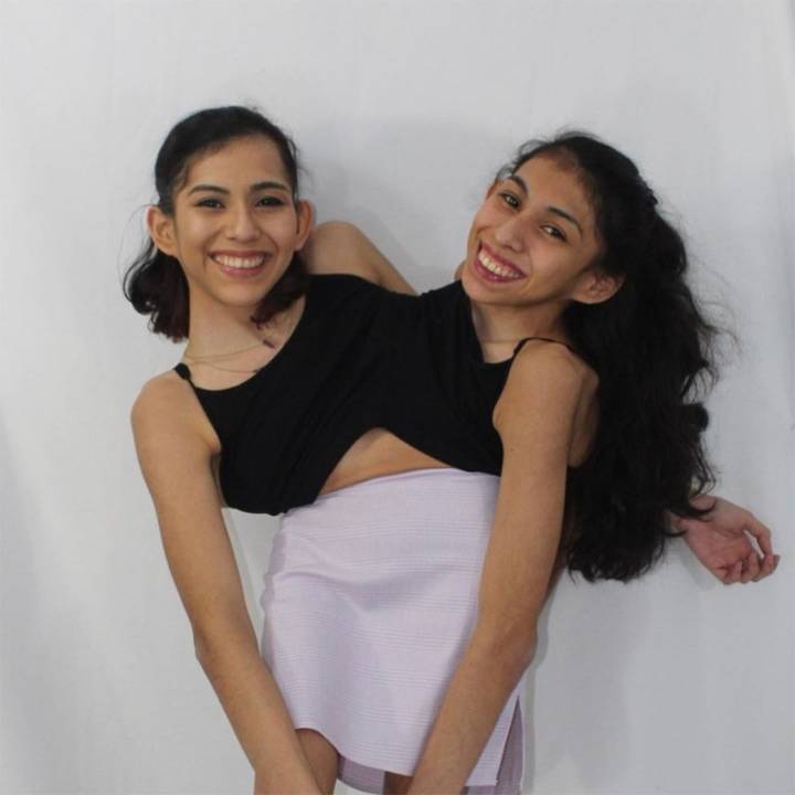 Conjoined Twin Carmen Andrade on Sex Life Speculation