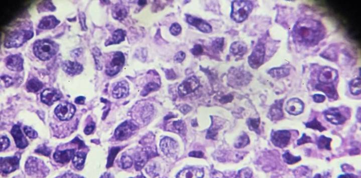 Osteosarcoma: tasas de supervivencia y factores que influyen en el pronóstico