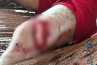 Campesino de Paz de Ariporo atacado por un animal silvestre requiere evacuación aérea desde distante vereda