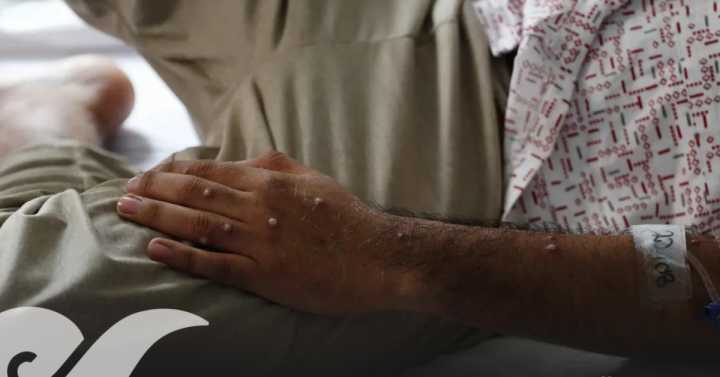 OMS levanta la emergencia internacional por mpox tras descenso de casos