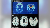 Study reveals pre-CTE damage in brains of even young contact