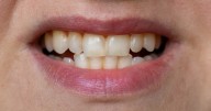 What colour of your teeth really means - from liver disease to fluorosis