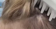 Preventing and treating lice