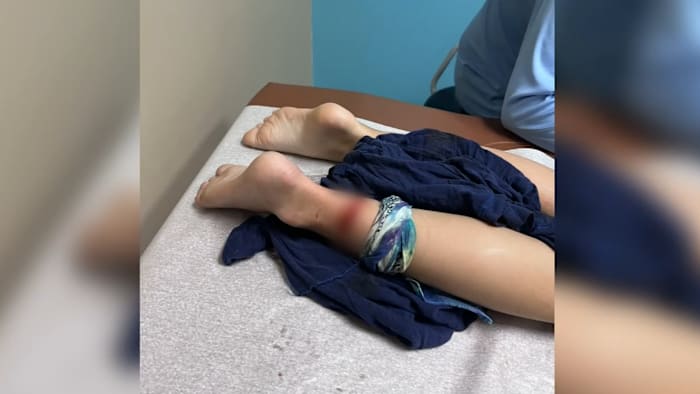 8-year-old girl bitten by possible shark at Galveston beach, report says
