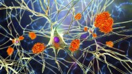 Europa aprueba el anticuerpo donanemab para frenar la progresión del alzheimer