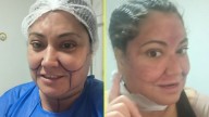 "Voy a quedar bonita": Denisse Campos mostró a través de redes sociales que se sometió a varios procedimientos estéticos