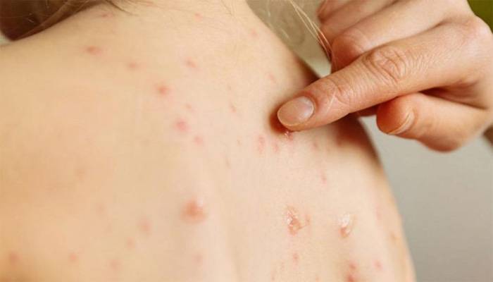 México registra 17 fallecimientos y 4 mil 353 casos confirmados de sarampión