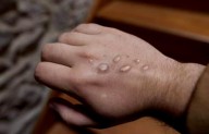 OMS: El mpox deja de ser una urgencia de salud internacional