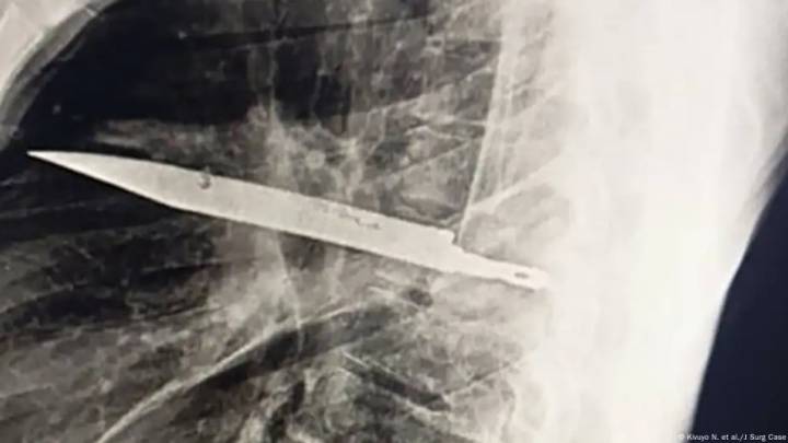 Impresionante caso es explicado por científicos: hombre vive 8 años con un cuchillo en el tórax sin saberlo