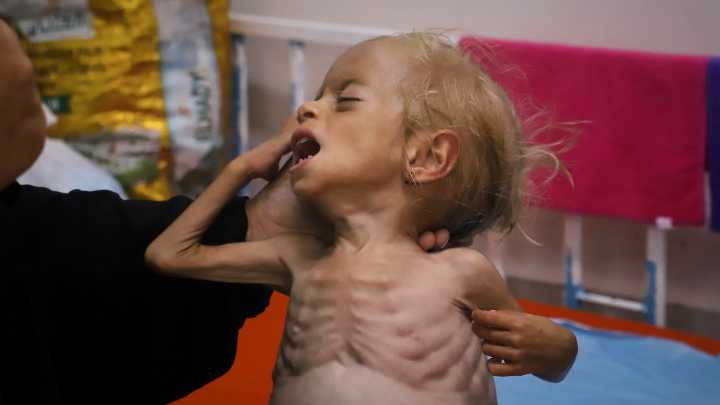 "Lesiones inusualmente graves", desnutrición y problemas psicológicos: los sanitarios en Gaza detallan el horror desde primera línea