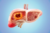 Chemotherapy-Associated Liver Injury Elevated by Genetic Variant in CRLM